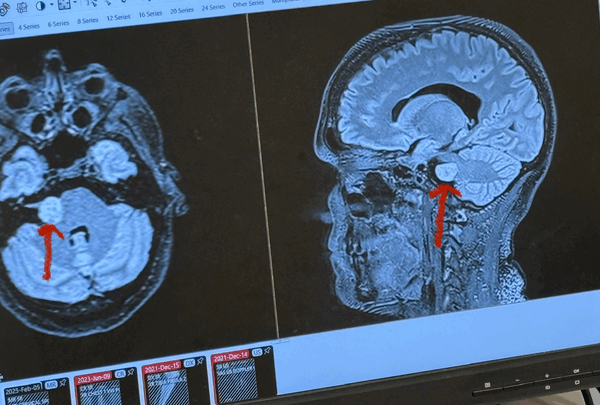 https://sadik-o.com - Brain Tumor Blues -- Brittany's Tumor GoFundMe