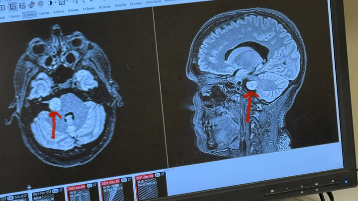 Brain Tumor Blues — Brittany’s Tumor GoFundMe