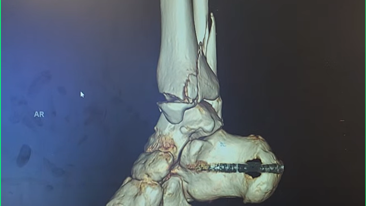 Killean’s Surgeries for Broken, Dislocated Ankle