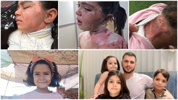 URGENT: Help Shahd Al-Baz Receive Burn Treatment Abroad - – Sadik-O