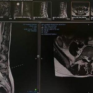 Painting via Pain: A Frida K response to x2 Spinal Surgeries - – Sadik-O