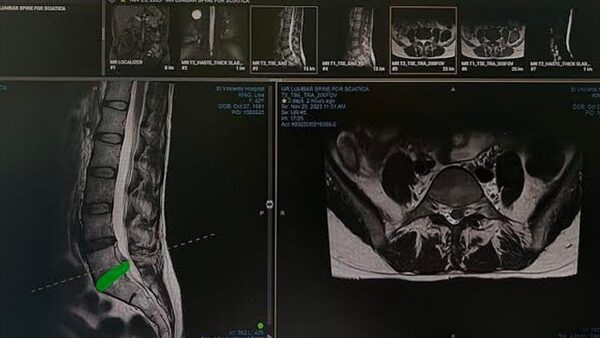 Painting via Pain: A Frida K response to x2 Spinal Surgeries - – Sadik-O