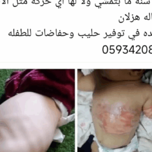 An appeal for the malnutritioned child Maryam