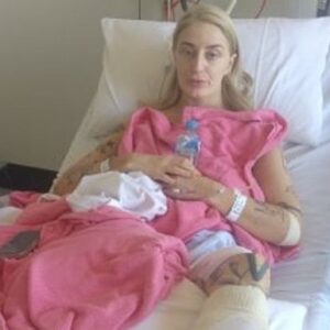 Ruby's Burns Recovery - – Sadik-O