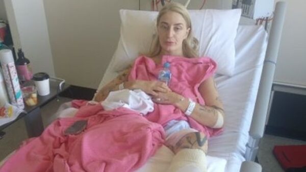 Ruby's Burns Recovery - – Sadik-O